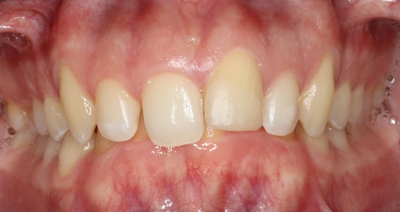 Before Teeth